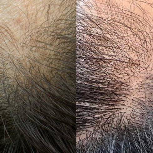 Scalp Micropigmentation