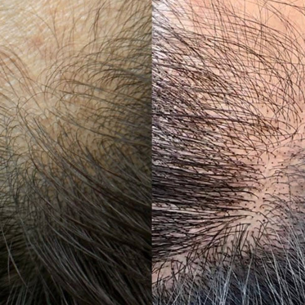 Scalp Micropigmentation